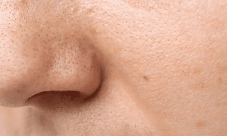 Home Remedies To Shrink Large Skin Pores