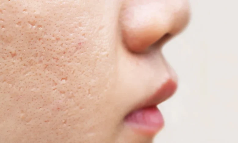 Home Remedies to Clear Acne Scars